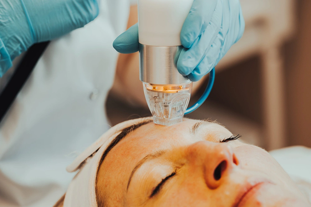 MICRONEEDLE RADIOFREQUENCY FACIAL