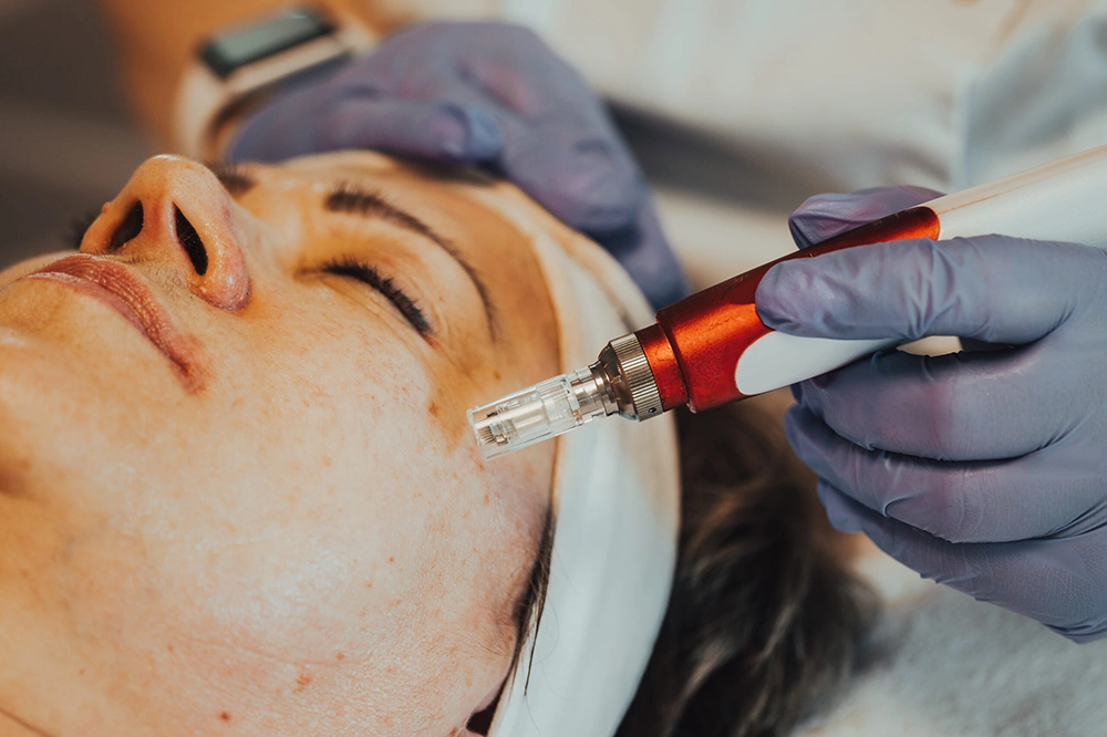 MICRONEEDLE FACIAL